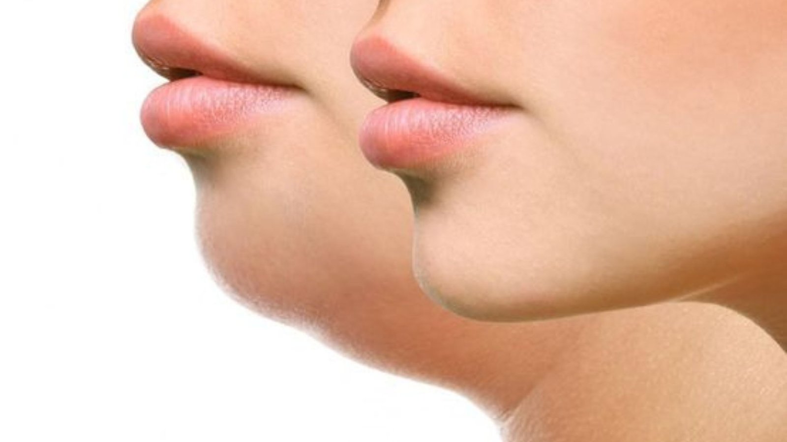 chin-vaser-liposuction