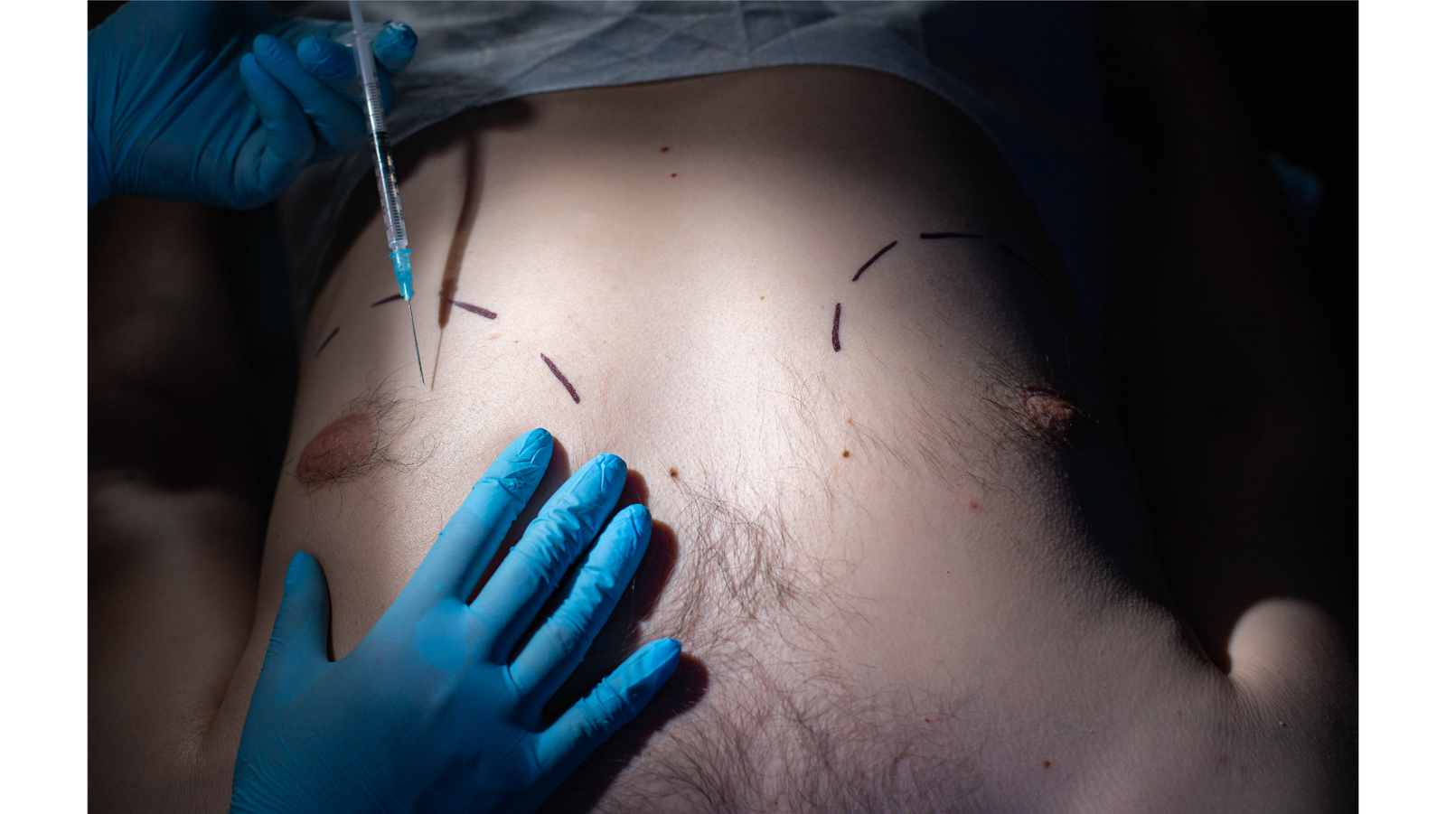 gynecomastia-surgery-recovery-tips