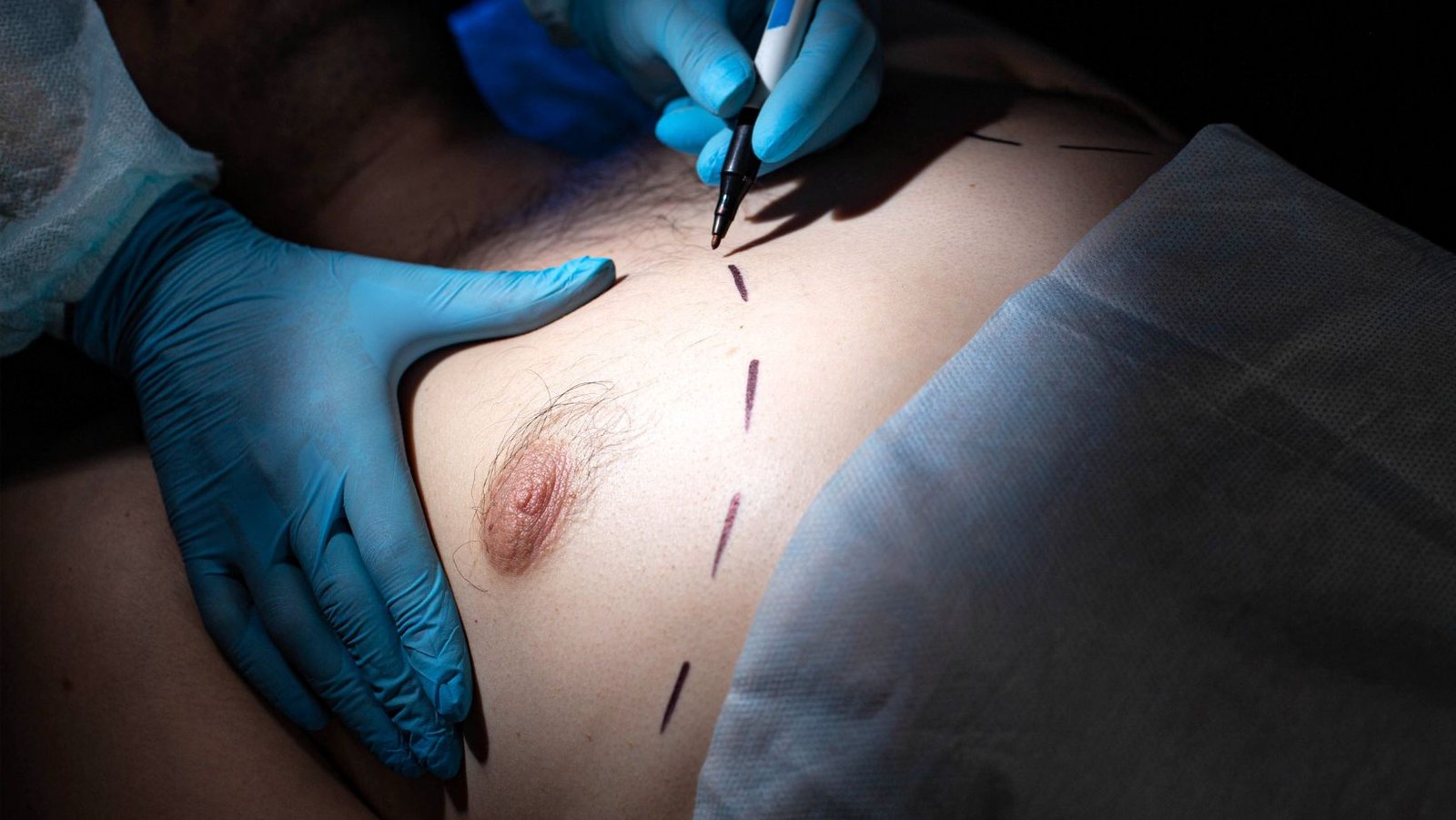 glandular-tissue-in-gynecomastia-surgery