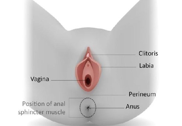 Chronic Perineal tear repair