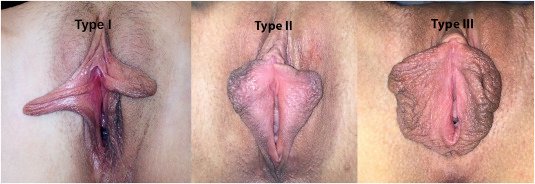 Labiaplasty in Delhi NCR