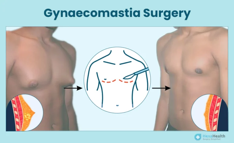 Gynecomastia surgery in delhi