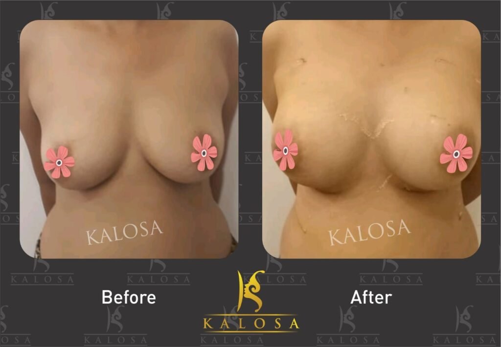 breast implant surgery before & after