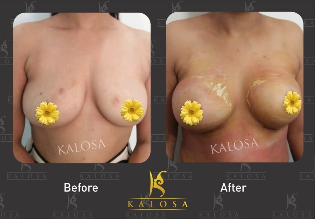 breast implant surgery before & after
