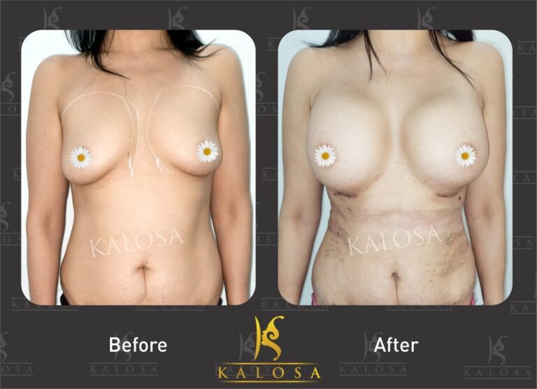 breast enlargement treatment before & after