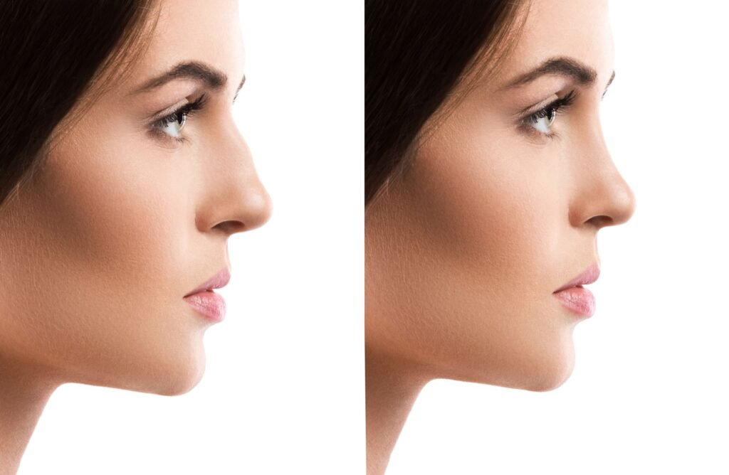 rhinoplasty surgery in delhi